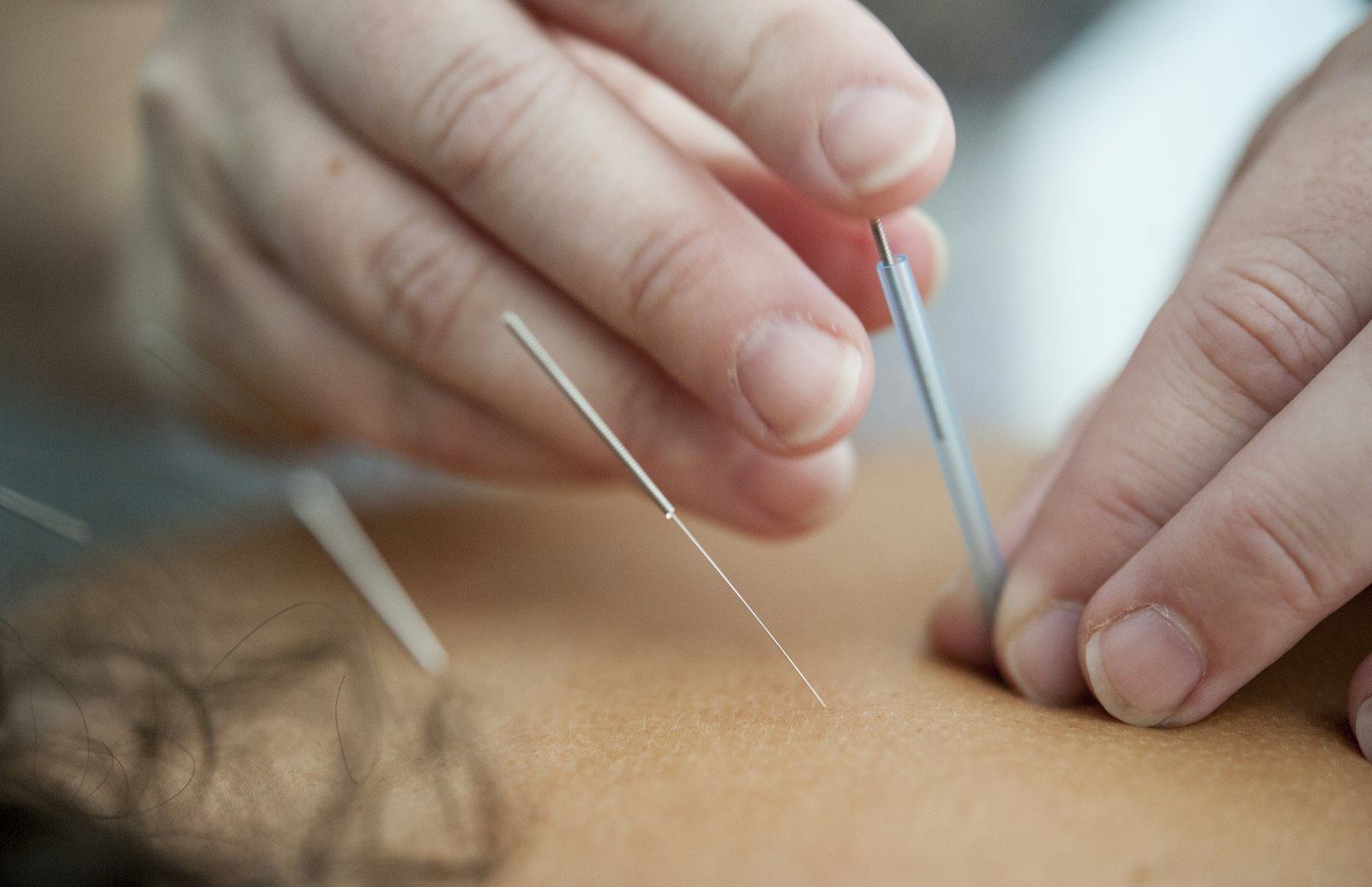A practitioner's fingers placing a fine acupuncture needle